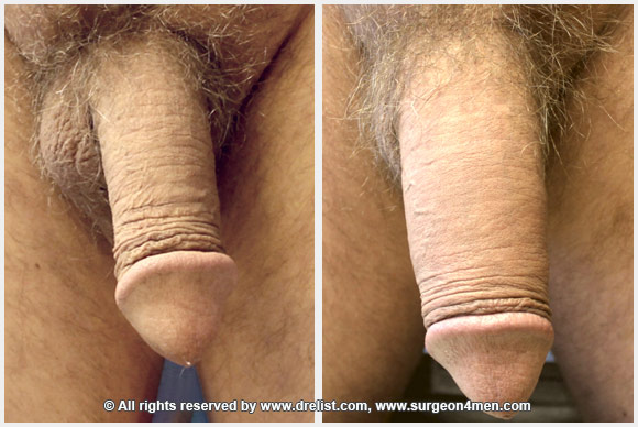 Penis enlargement, penuma, male enhancement, penis implant, penile prosthesis, Titan implant, best penile implant.