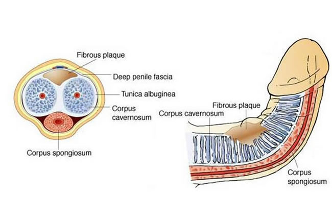 Peyronies Disease