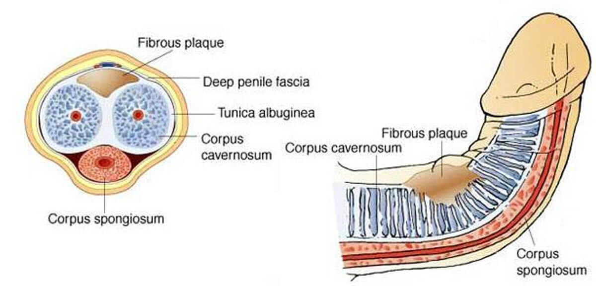 Peyronies Disease