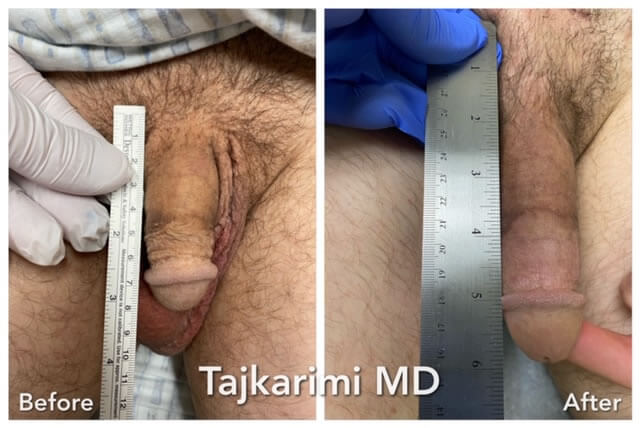 Penis Implant