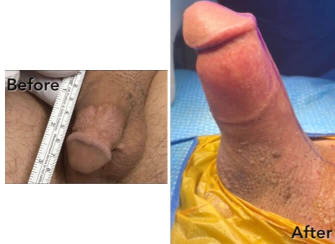 Penis enlargement, penuma, male enhancement